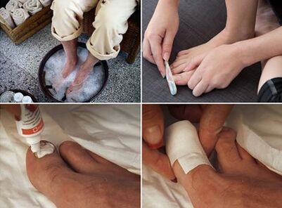 Napařování nohou a aplikace močovinového krému na nehty postižené houbami