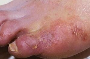 projevy plísňové infekce na kůži nohou
