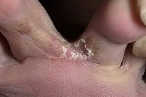 kožní plíseň mezi prsty na nohou