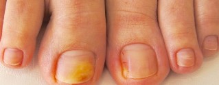 nail houba na nohou, příznaky